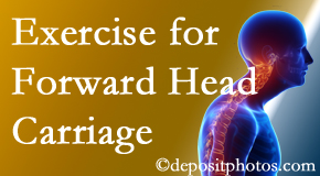 Largo chiropractic treatment of forward head carriage is two-fold: manipulation and exercise.