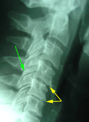 disc degeneration treated at Hollstrom & Associates Inc