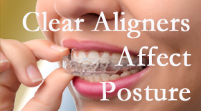 Clear aligners influence posture which Largo chiropractic helps.