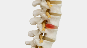 Largo chiropractic conservative care helps even huge disc herniations go away