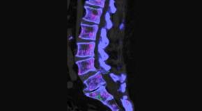 Hollstrom & Associates Inc is aware that inflammatory spinal gout is a differential diagnosis to consider for patients who present with back pain and other spine related symptoms.