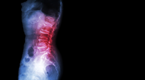 Largo Chiropractic Care of Spondylolisthesis 