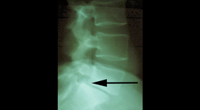 Largo spondylolisthesis 