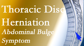 Hollstrom & Associates Inc treats thoracic disc herniation that for some patients prompts abdominal pain.