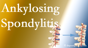 Hollstrom & Associates Inc offers gentle chiropractic spinal manipulation in the form of Cox Technic for ankylosing spondylitis management.