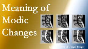 Hollstrom & Associates Inc sees many back pain and neck pain patients who bring their MRIs with them to the office. Modic changes are often seen. 