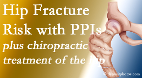 Hollstrom & Associates Inc shares new research describing increased risk of hip fracture with proton pump inhibitor use. 