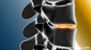 Largo degenerative spinal changes 