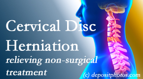 Hollstrom & Associates Inc offers the Cox® Technic spinal manipulation to treat cervical radiculopathy and avert surgery. 