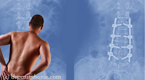Largo chiropractic relief for back pain after back surgery