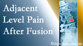 Hollstrom & Associates Inc offers relieving care non-surgically to back pain patients suffering with adjacent level pain after spinal fusion surgery.