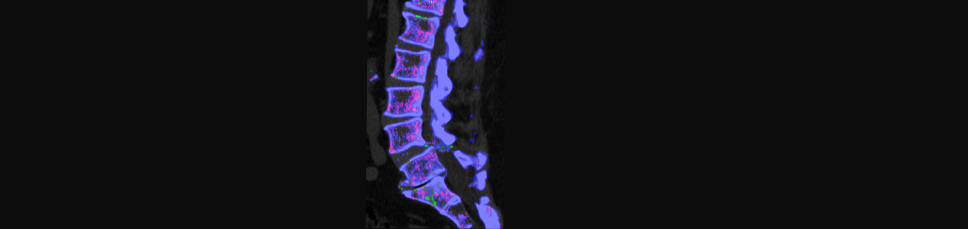 Hollstrom & Associates Inc is aware that inflammatory spinal gout is a differential diagnosis to consider for patients who present with back pain and other spine related symptoms.