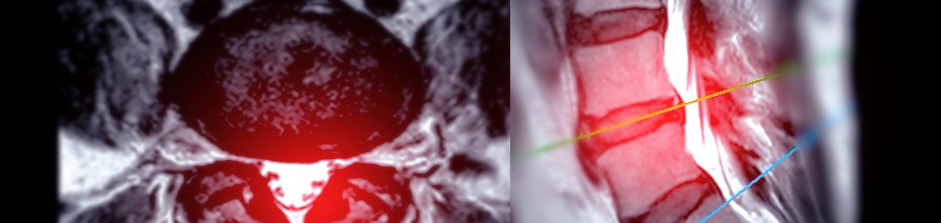 Largo back pain imaging and exercise