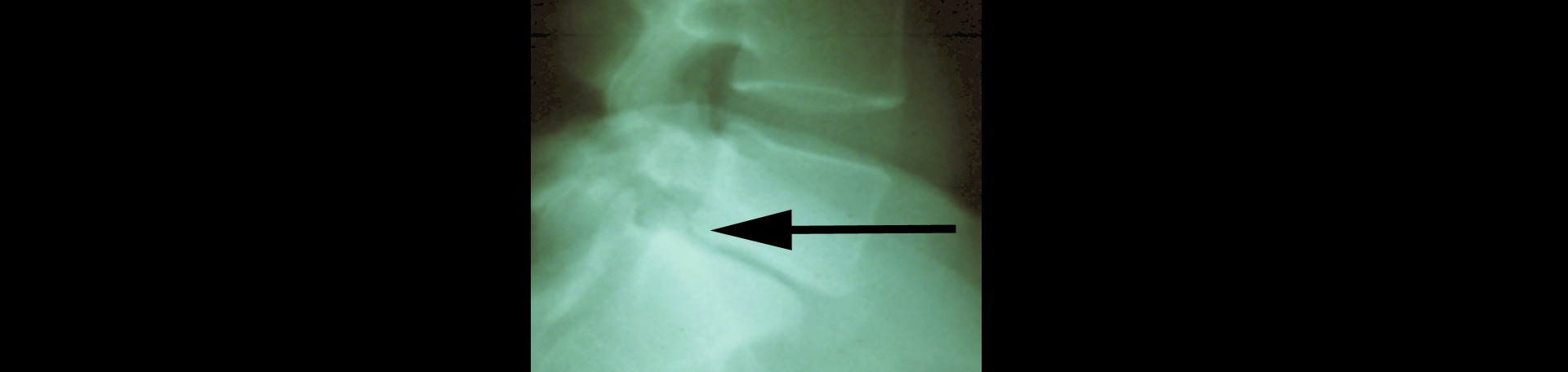 Largo spondylolisthesis