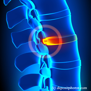 picture of lumbar Largo disc herniation