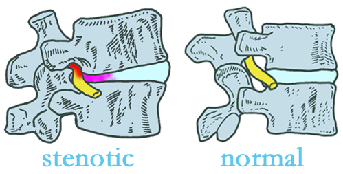 Largo stenotic and normal spinal discs